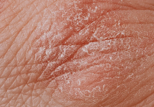 krem na oparzenia i podrażnioną skórę suchość skóry